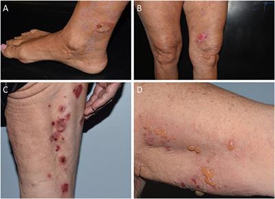 Bullous Pemphigoid Associated With COVID-19 Vaccines: An Italian Multicentre Study